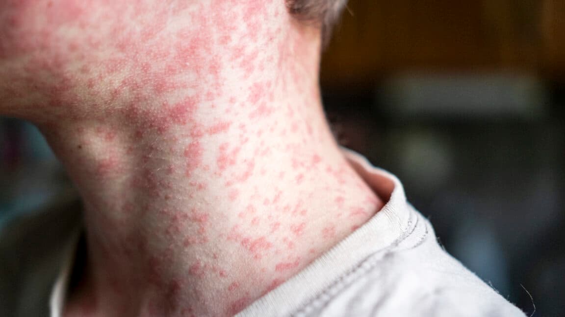 Over 250 people quarantined in South Carolina as measles outbreak rages