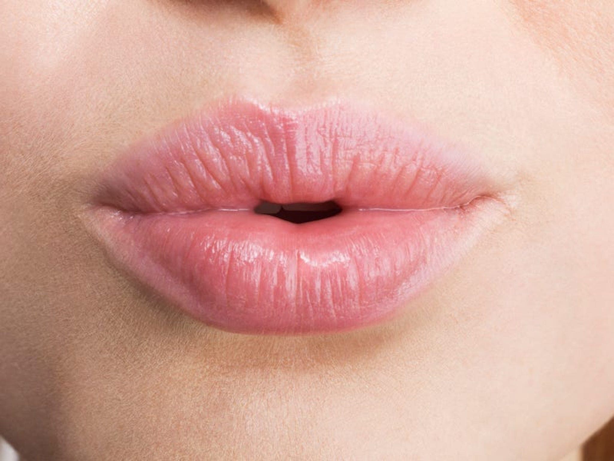 What To Expect Before And After Getting Your Lip Filler Dissolved